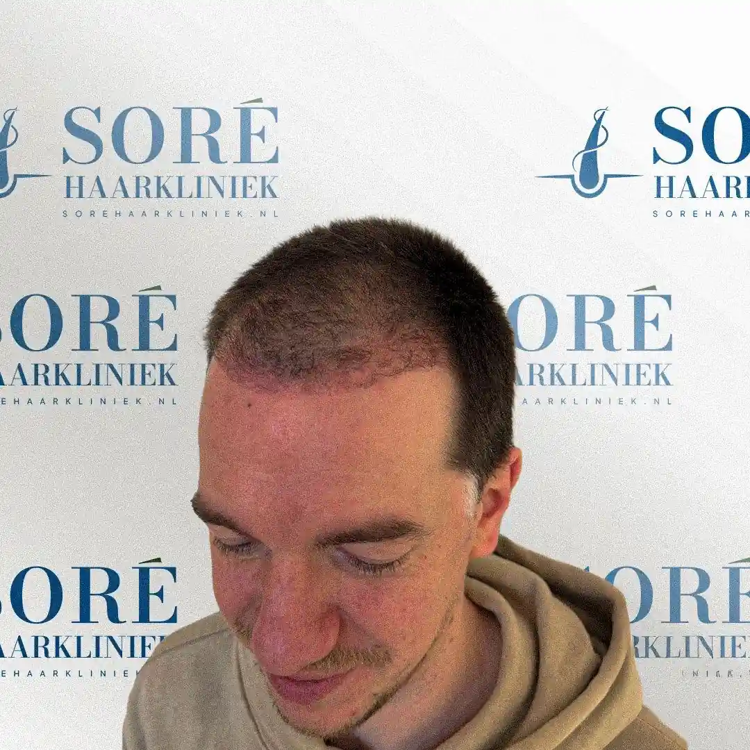 Cliënt van Soré Haarkliniek voor de haartransplantatie