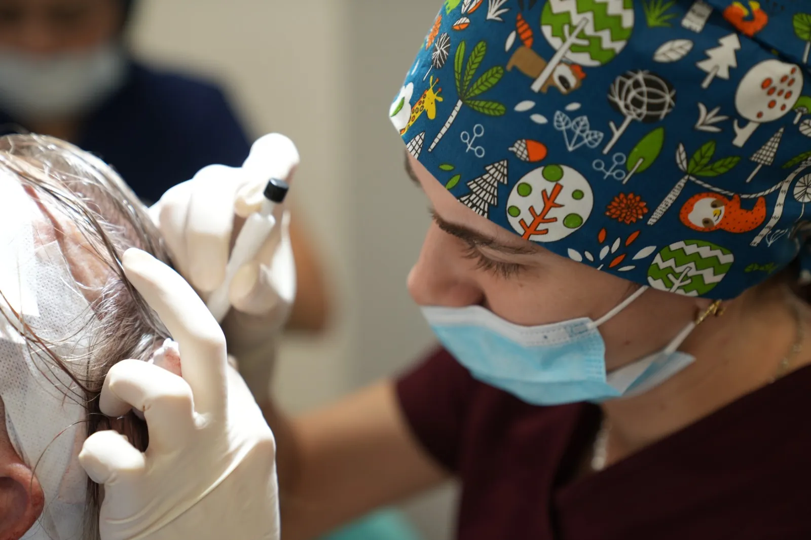 Plaatsing van de grafts tijdens de haartransplantatie bij Soré Haarkliniek