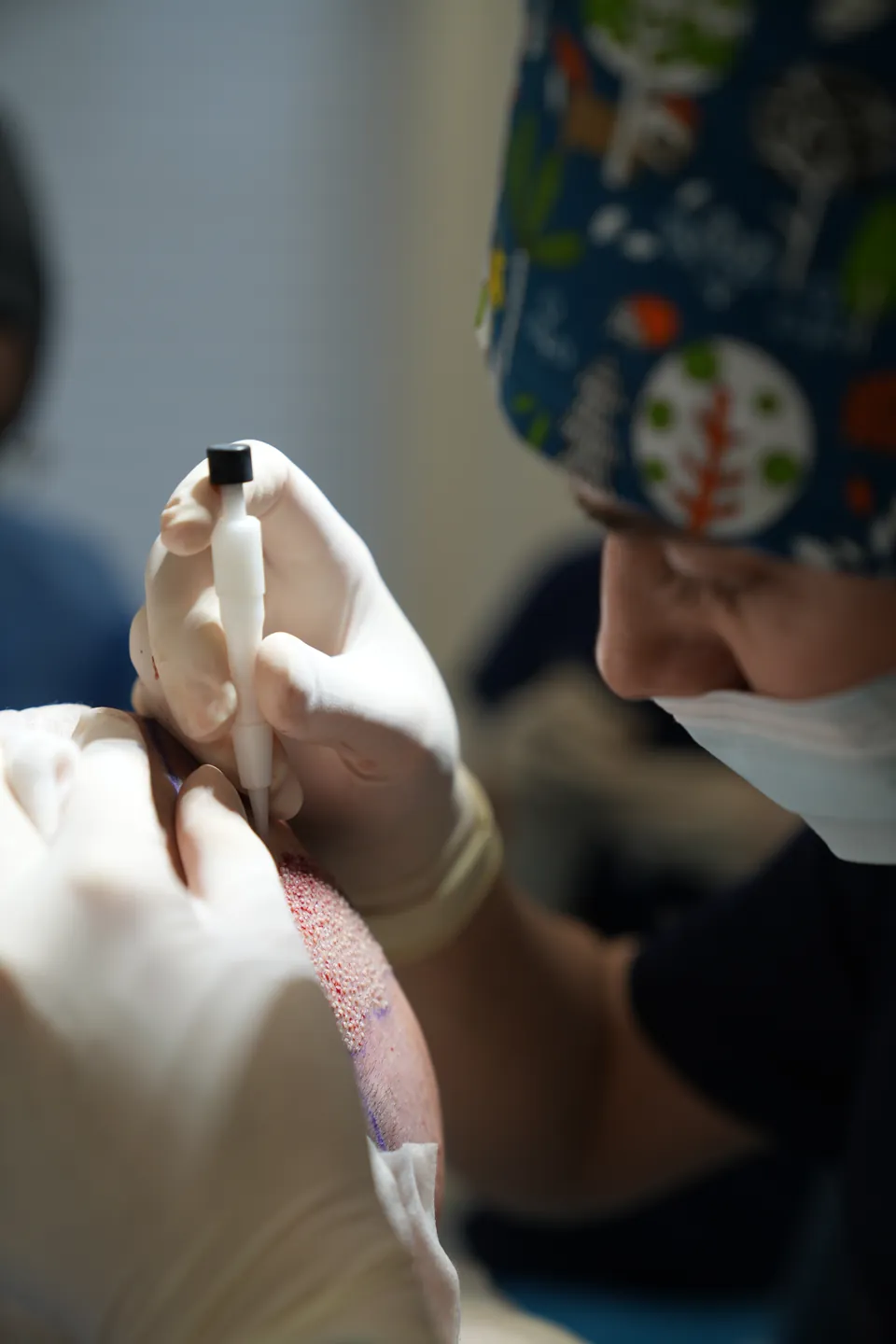 Detail van een DHI implantatie bij Soré Haarkliniek
