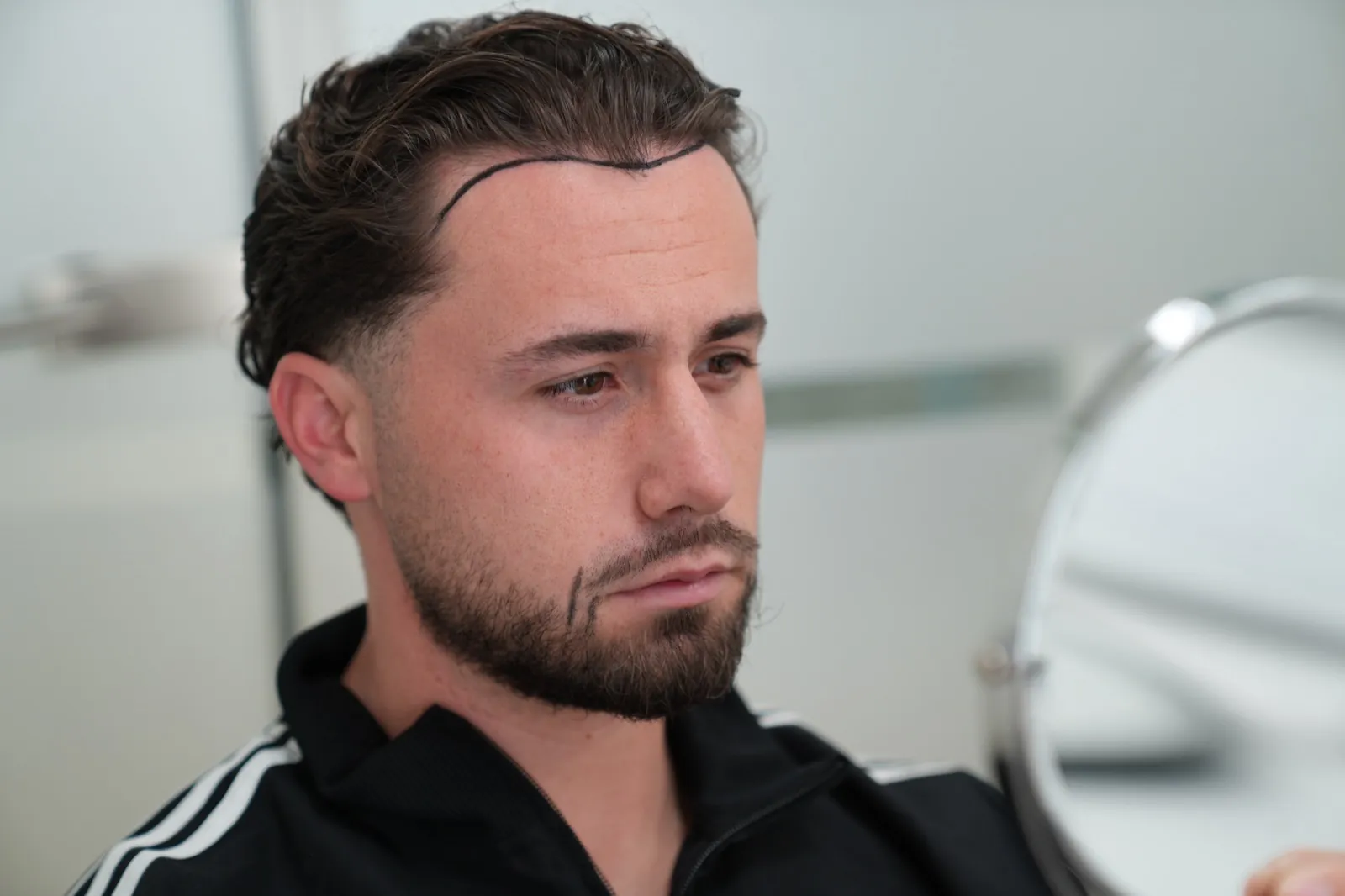 Beoordeling van haarlijn en geschiktheid voor een DHI haartransplantatie