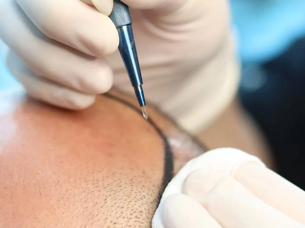 Saffier FUE haartransplantatie behandeling