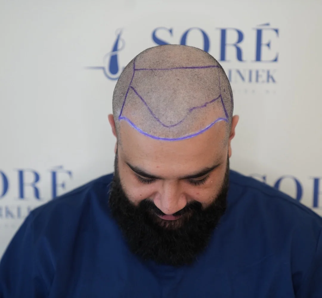 Haartransplantatie van Ahmed - beeld voor de behandeling