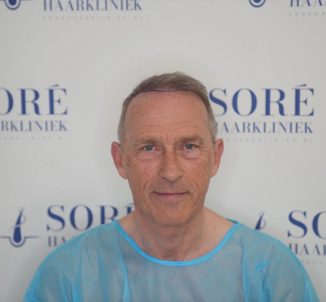 Haartransplantatie van Andries - beeld voor de behandeling