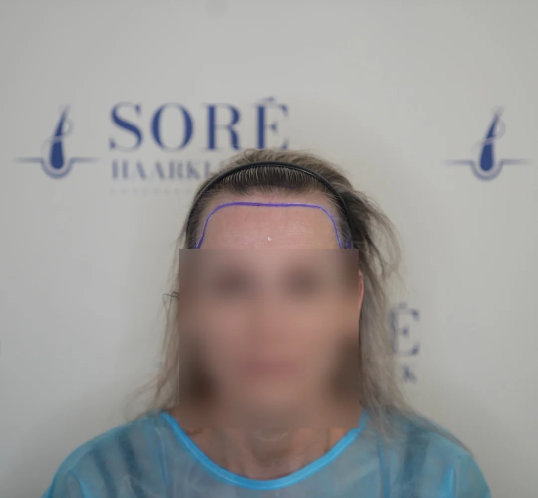 Haartransplantatie van Anouk - beeld voor de behandeling