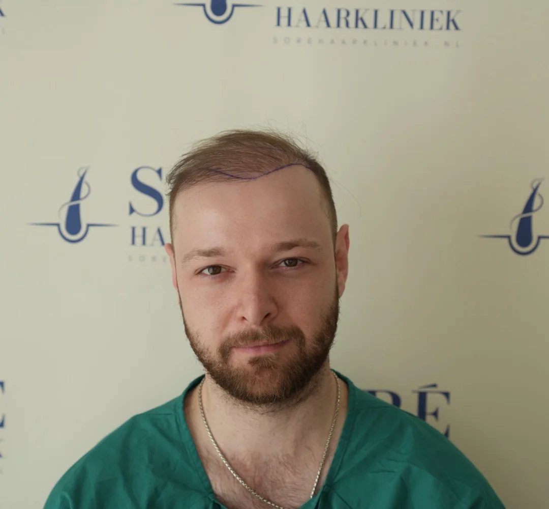 Haartransplantatie van Anton - beeld voor de behandeling