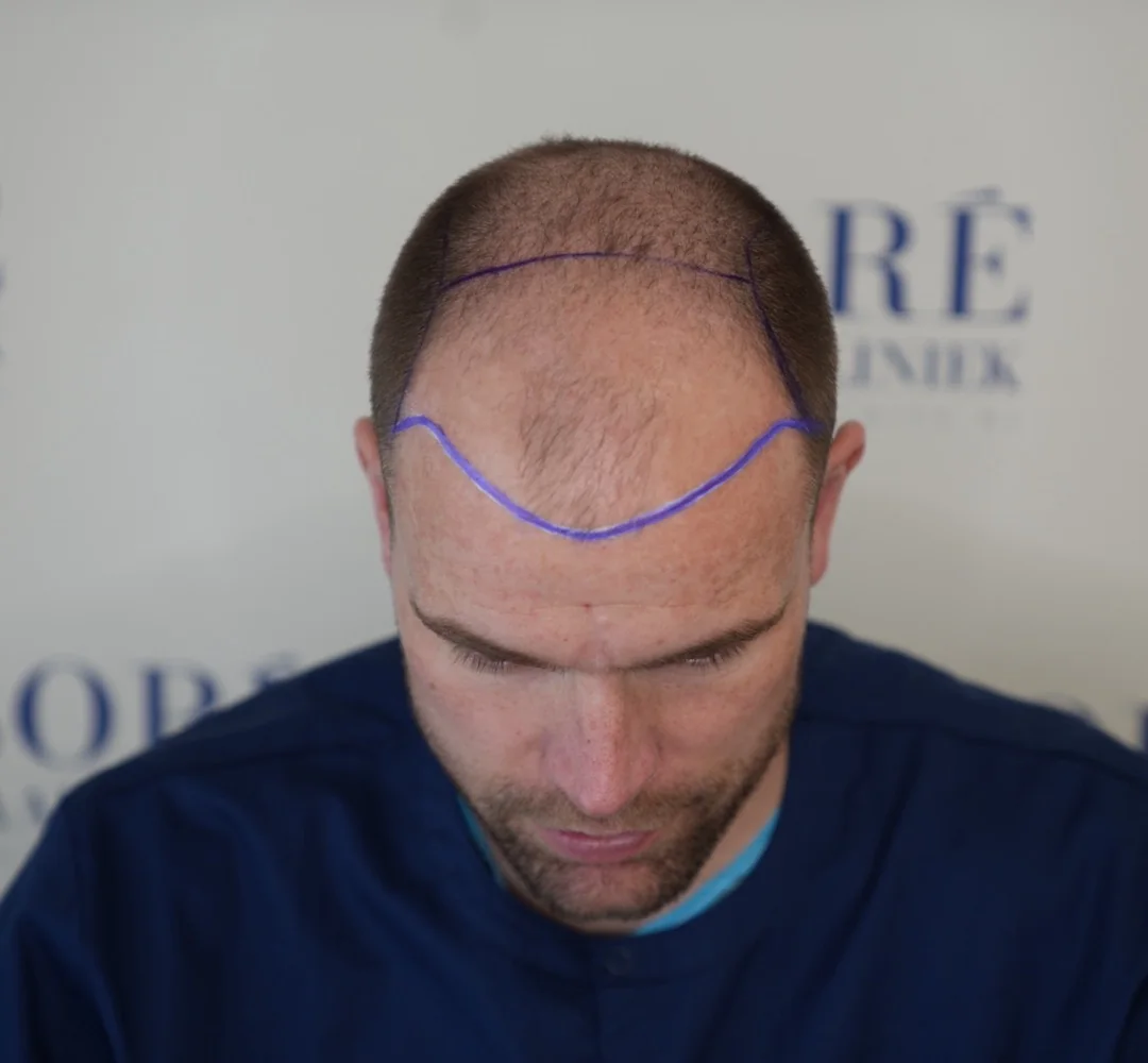 Haartransplantatie van Arjan - beeld voor de behandeling