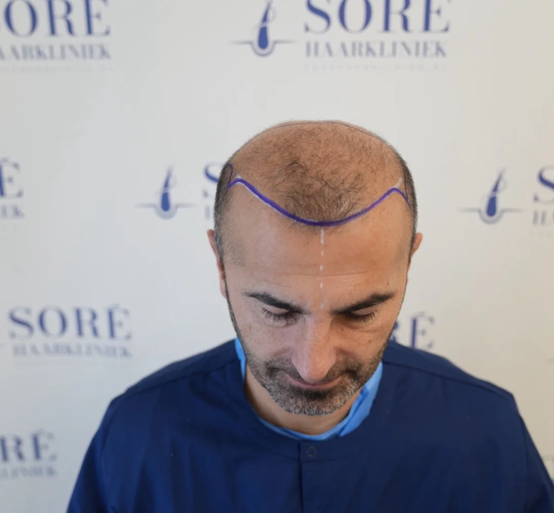 Haartransplantatie van Barış - beeld voor de behandeling