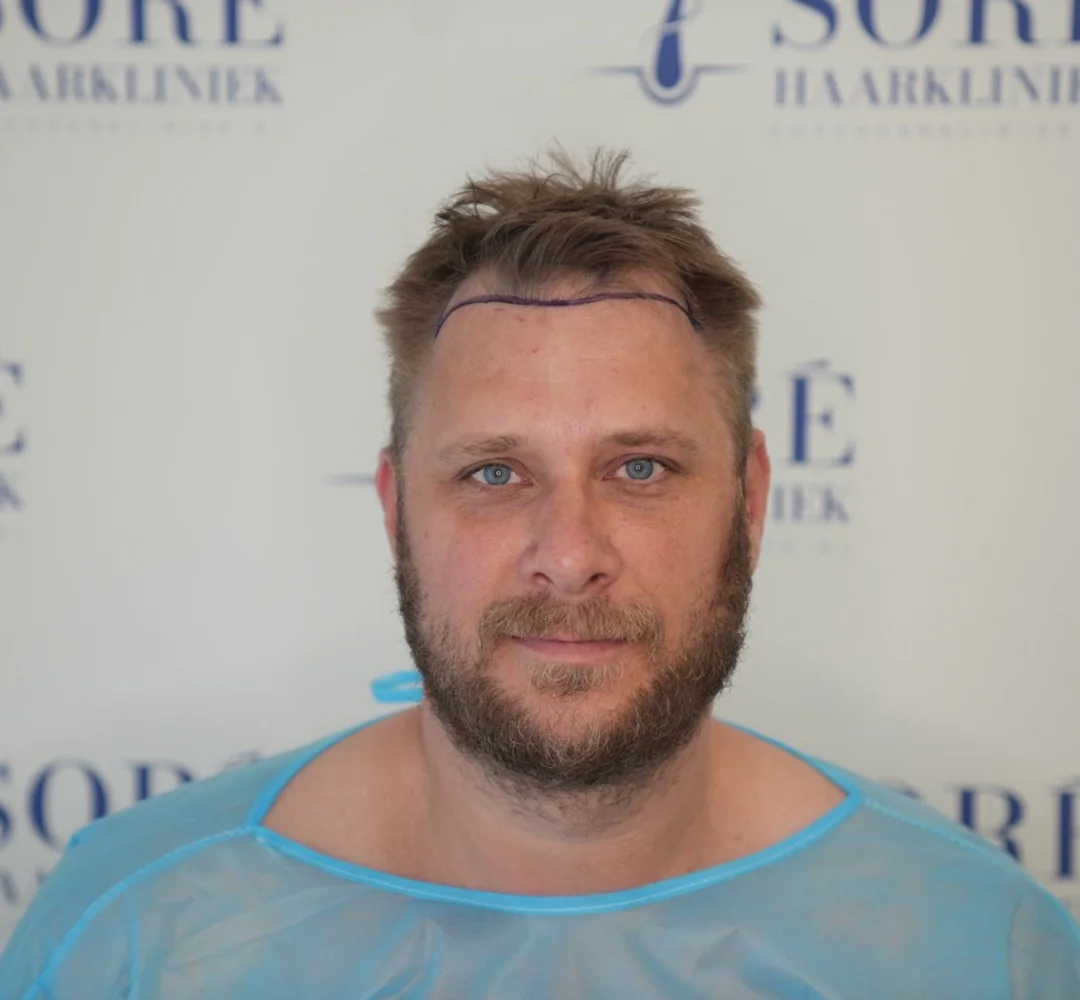 Haartransplantatie van Boy Frenk - beeld voor de behandeling