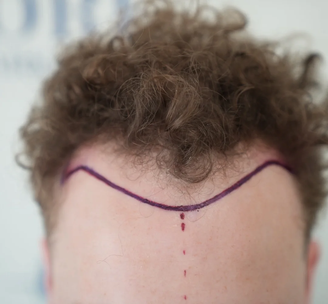 Haartransplantatie van Coen - beeld voor de behandeling