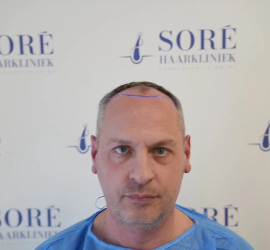 Haartransplantatie van Floor - beeld voor de behandeling