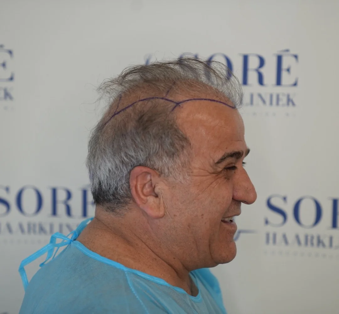 Haartransplantatie van Hakan - beeld voor de behandeling