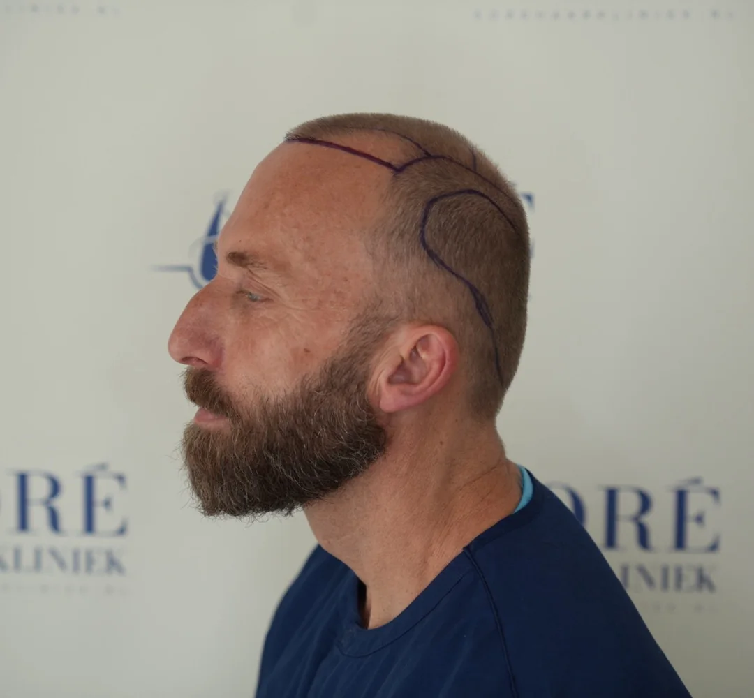 Haartransplantatie van Heroen - beeld voor de behandeling