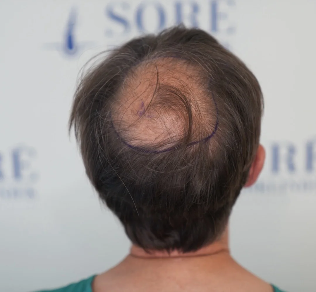 Haartransplantatie van James - beeld voor de behandeling