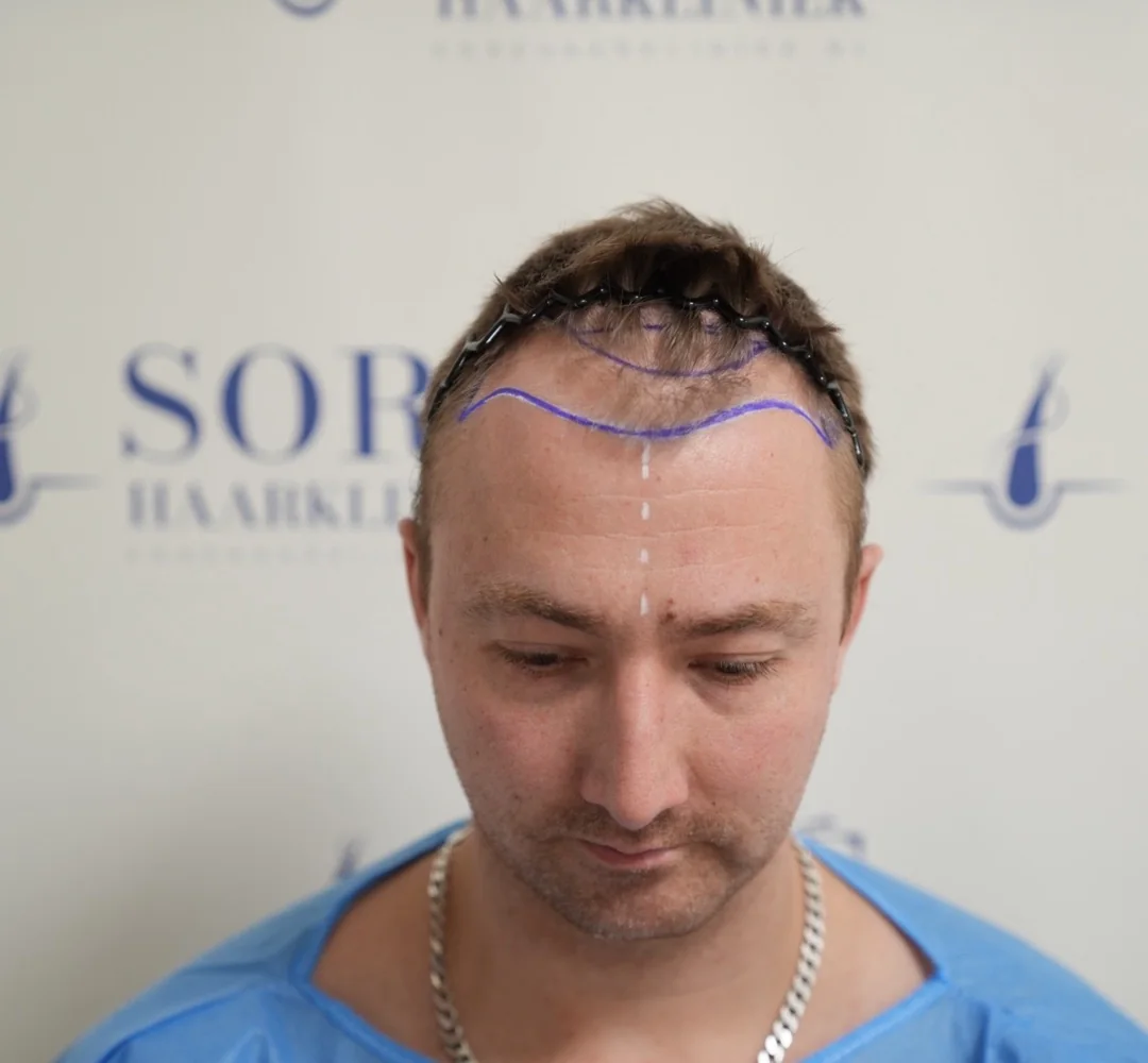 Haartransplantatie van Joey - beeld voor de behandeling