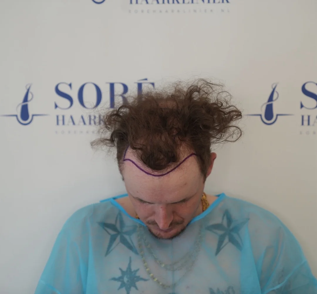 Haartransplantatie van Jorick - beeld voor de behandeling