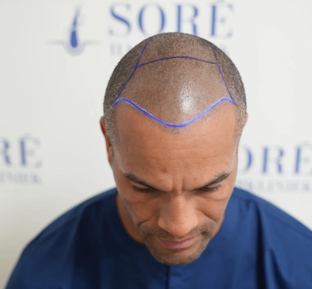 Haartransplantatie van Jose - beeld voor de behandeling