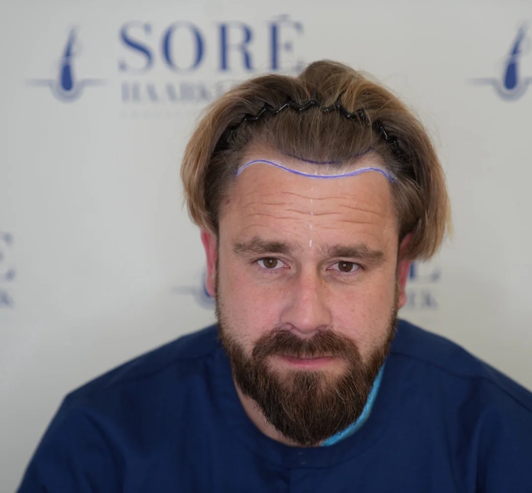 Haartransplantatie van Menno - beeld voor de behandeling