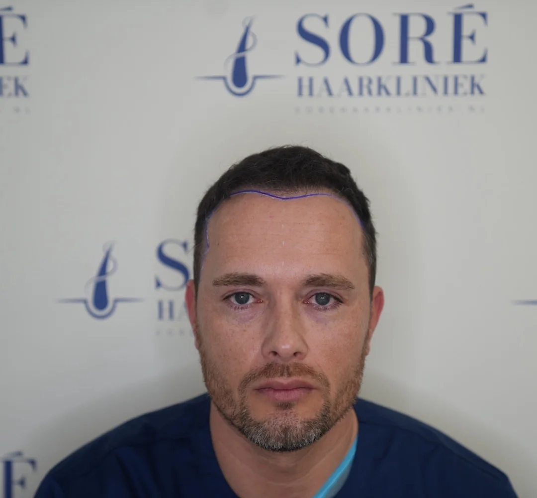 Haartransplantatie van Michael - beeld voor de behandeling