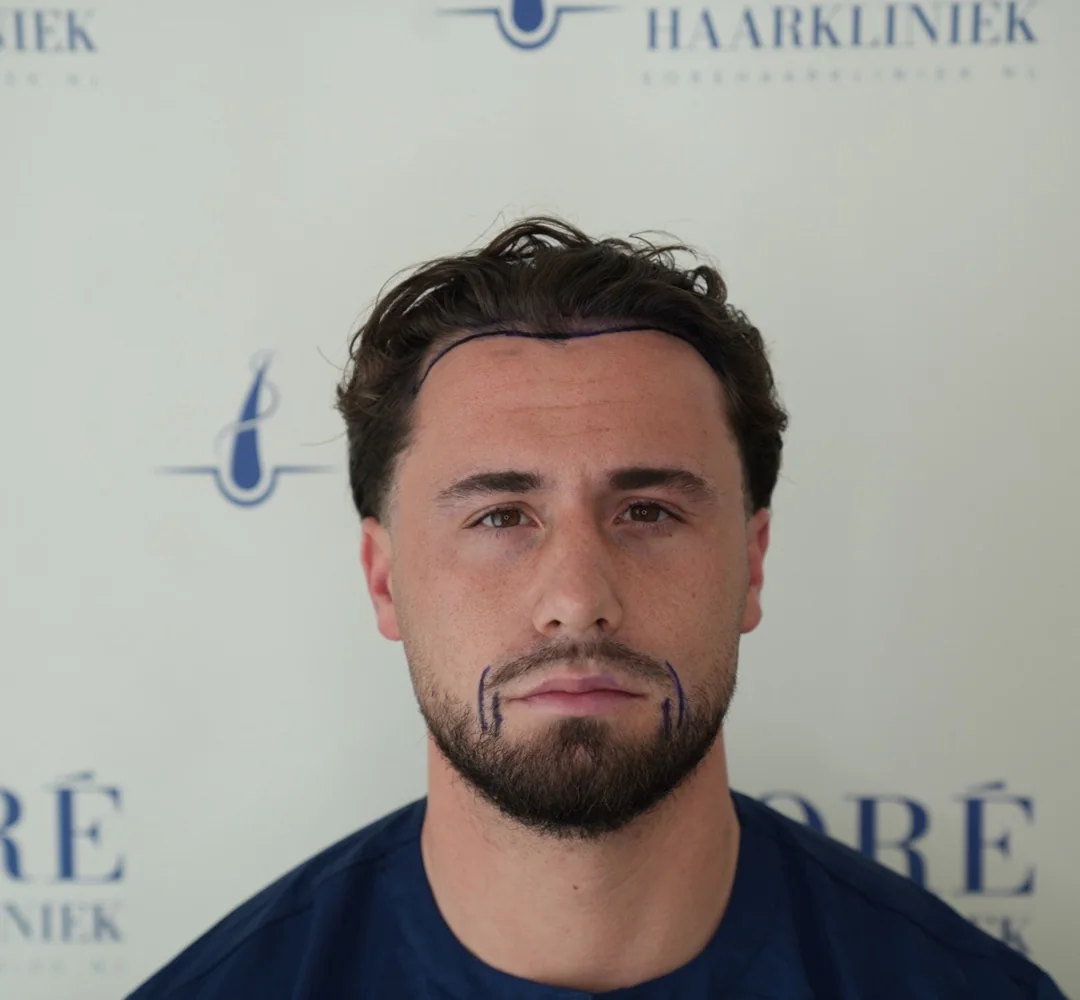 Haartransplantatie van Rick - beeld voor de behandeling