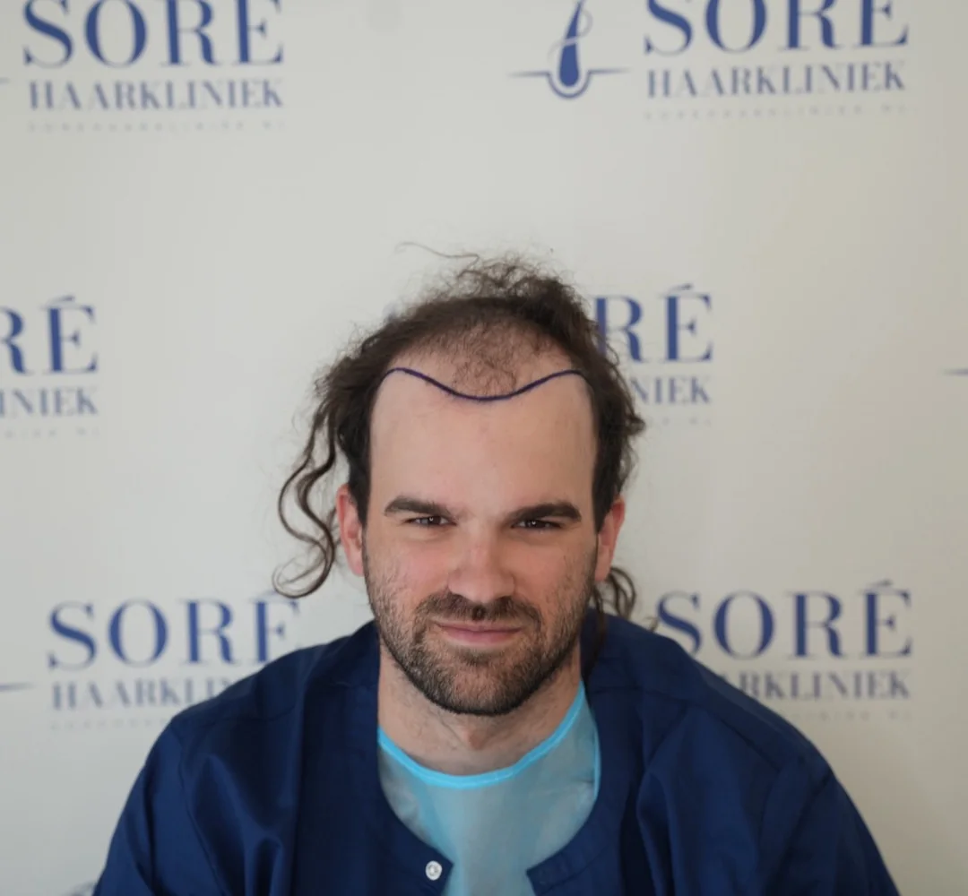 Haartransplantatie van Robert - beeld voor de behandeling