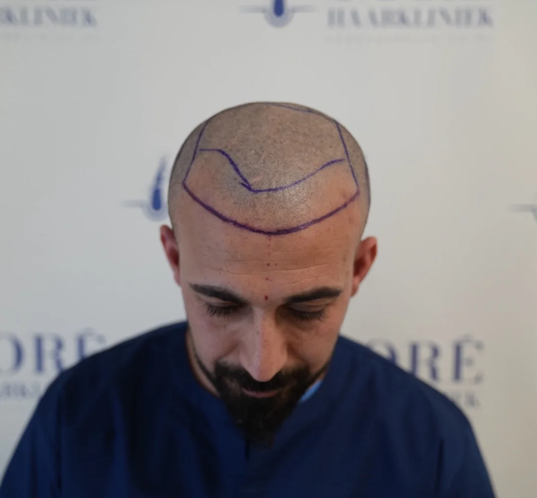 Haartransplantatie van Sait - beeld voor de behandeling