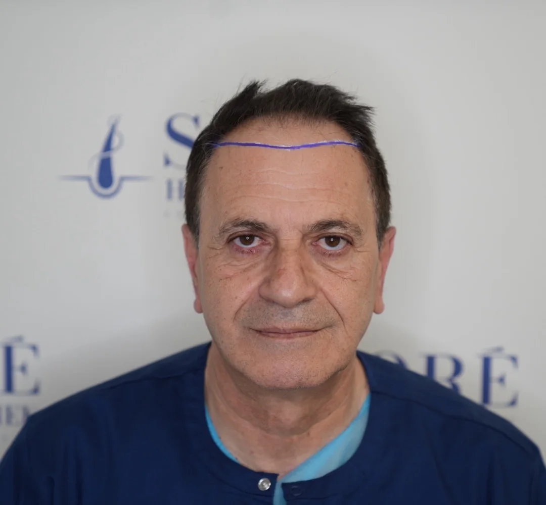 Haartransplantatie van Sarkis - beeld voor de behandeling