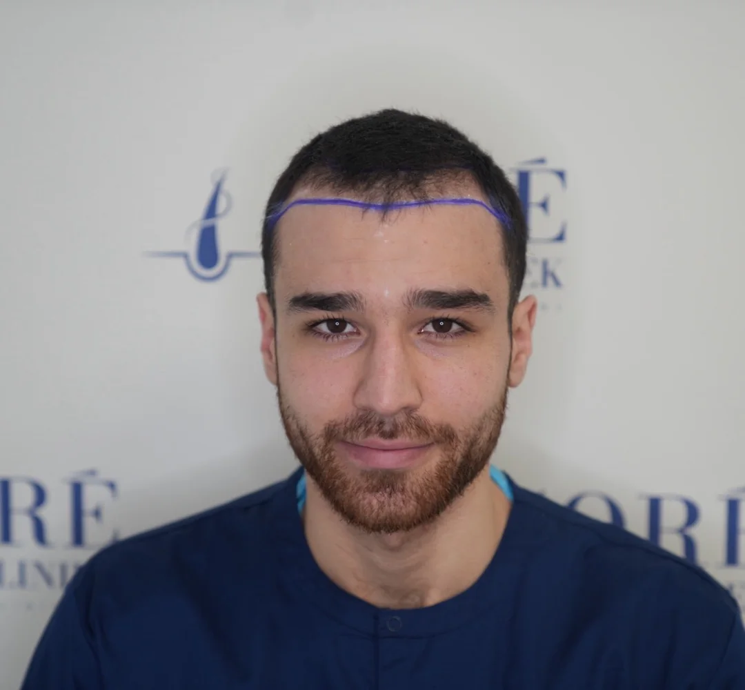 Haartransplantatie van Şükrü - beeld voor de behandeling