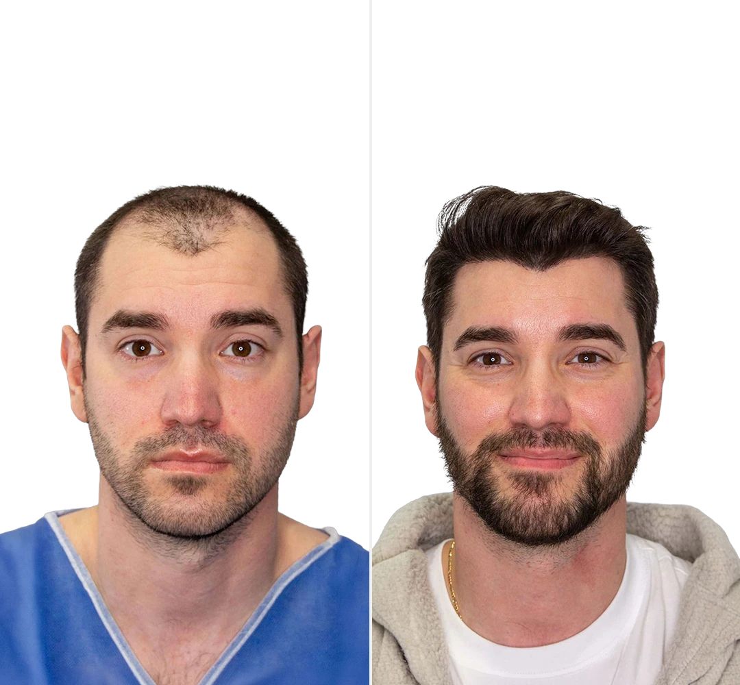 Voor en na resultaat van Bram - DHI haartransplantatie