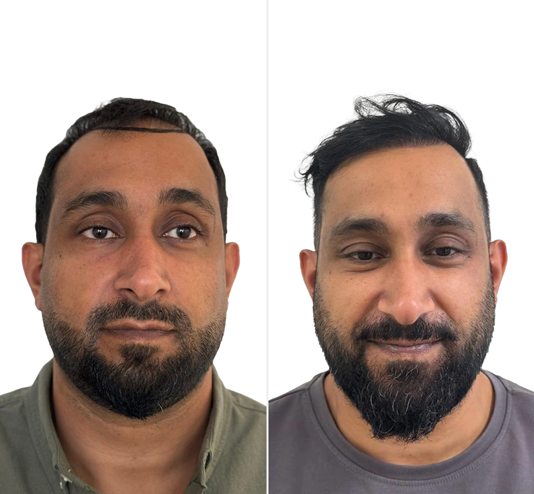 Voor en na resultaat van Mohammed - Saffier FUE haartransplantatie