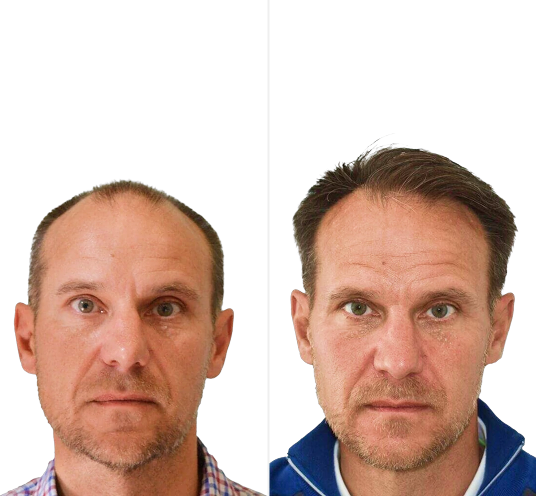 Voor en na resultaat van Peter - DHI haartransplantatie